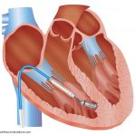 Heart Implant illustration for Medtronic, Inc. Vector art created using Adobe Illustrator.